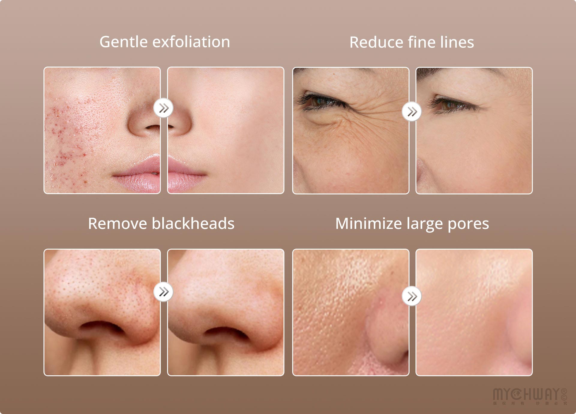 diamond microdermabrasion facial peel beauty machine