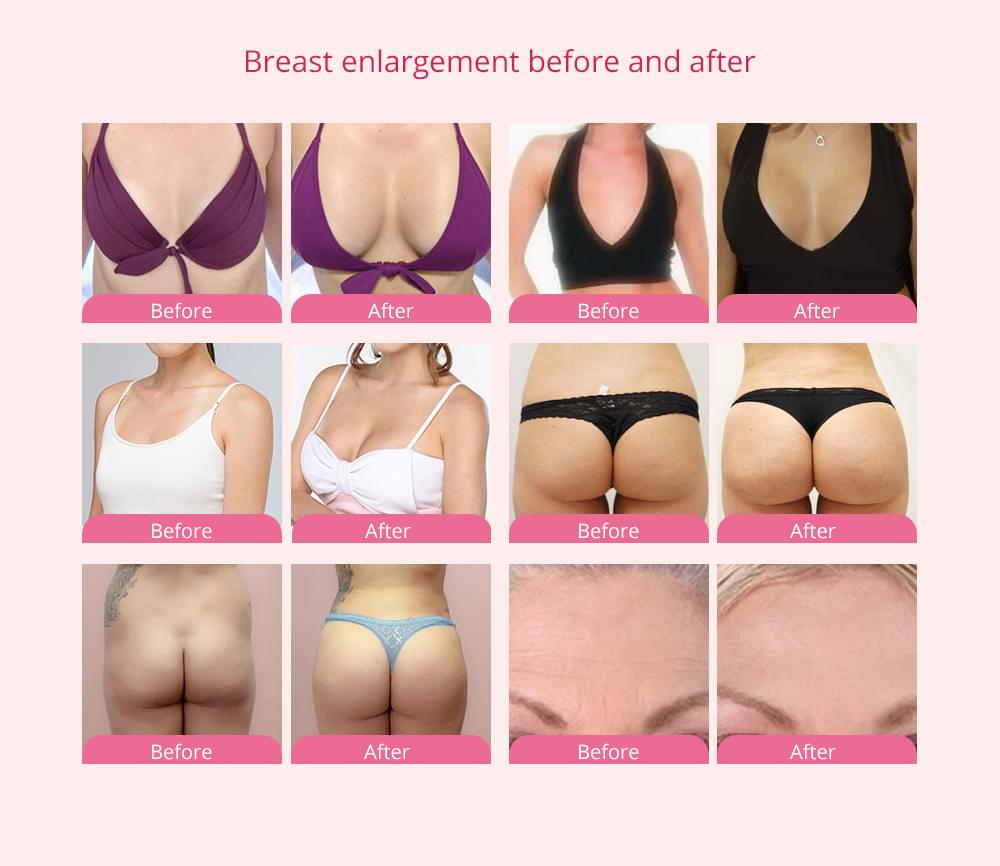 Breast massage before and after