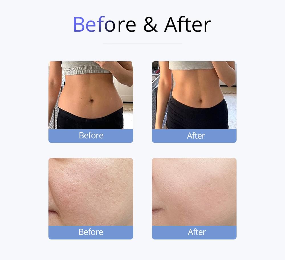 Best Cavitation machine before and after