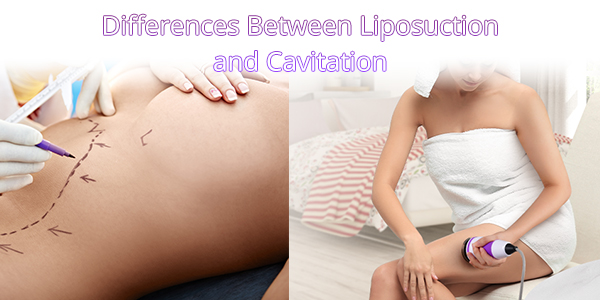 Differences Between Liposuction and Cavitation