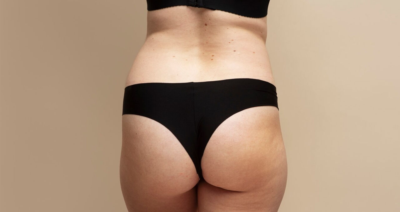 How to Get a Butt Lift Without Surgery?