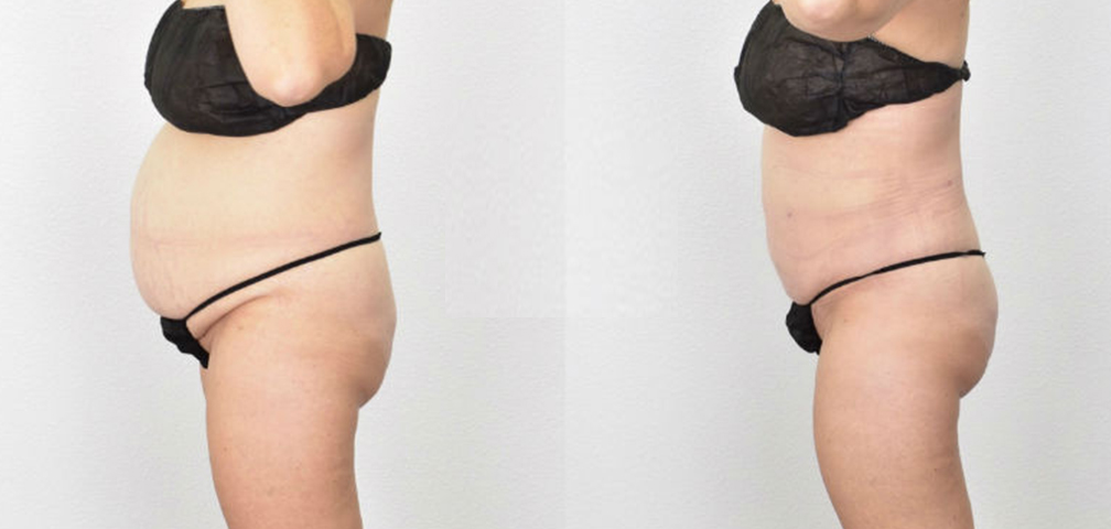 cavitation before and after comparison