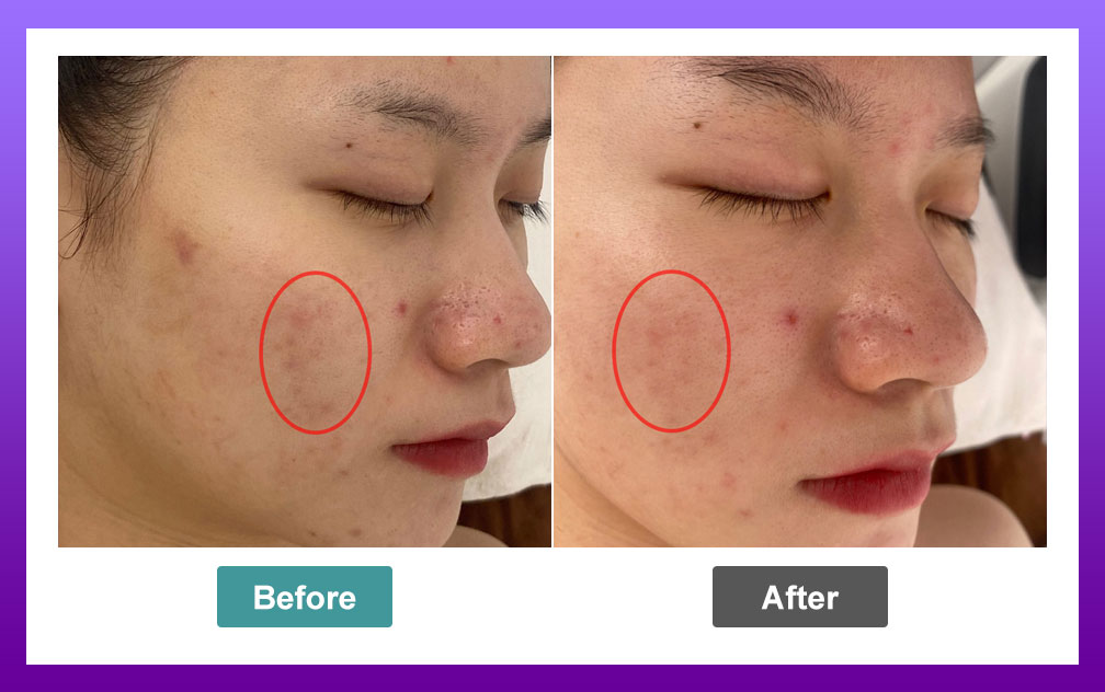 Real Results: Hydrodermabrasion Before and After