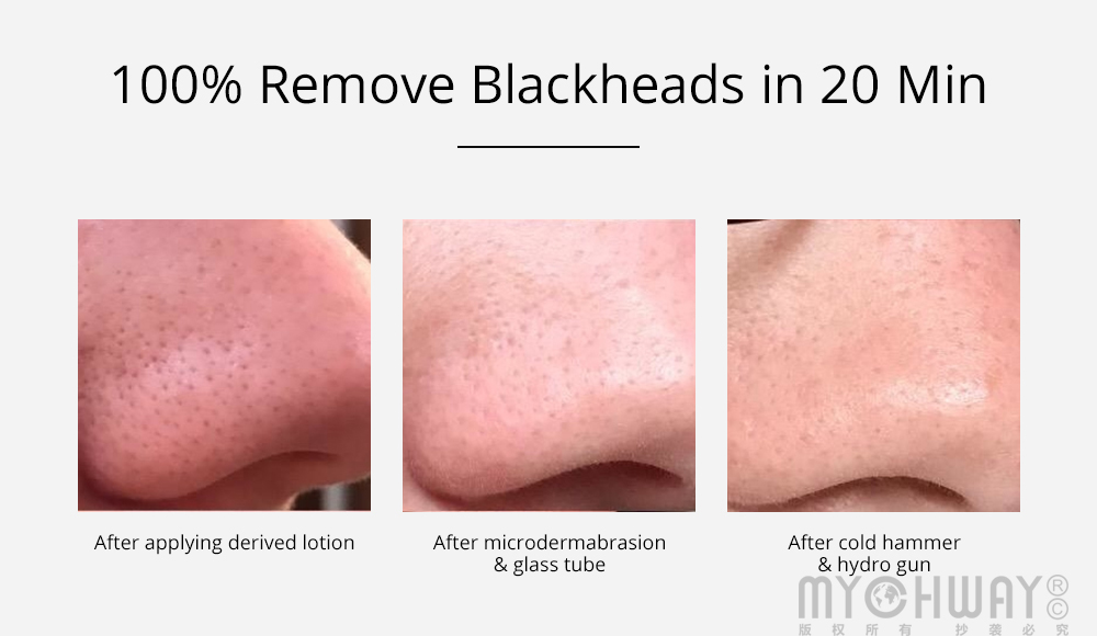 diamond dermabrasion oxygen jet blackhead removal hot & cold hammer machine